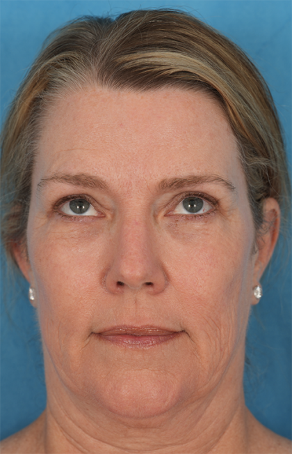Four Lid Blepharoplasty Before & After Patient #394
