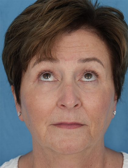 Four Lid Blepharoplasty Before & After Patient #401