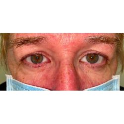 Lesion Removal Before & After Patient #356