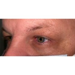 Lesion Removal Before & After Patient #358
