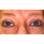 Ptosis Repair Before & After Patient #624