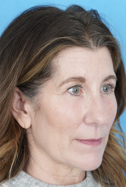 Lower Blepharoplasty Before & After Patient #525