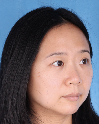 Lower Blepharoplasty Before & After Patient #524