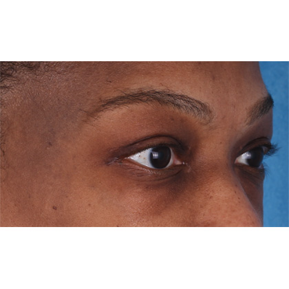 Upper Blepharoplasty Before & After Patient #693