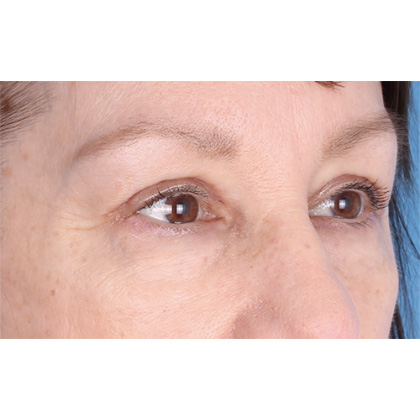 Upper Blepharoplasty Before & After Patient #695