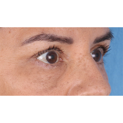 Upper Blepharoplasty Before & After Patient #696