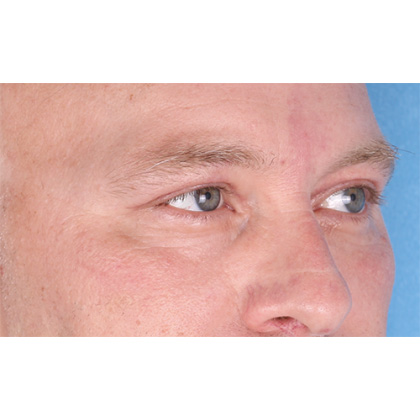 Upper Blepharoplasty Before & After Patient #697