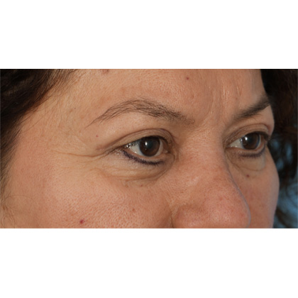 Upper Blepharoplasty Before & After Patient #701