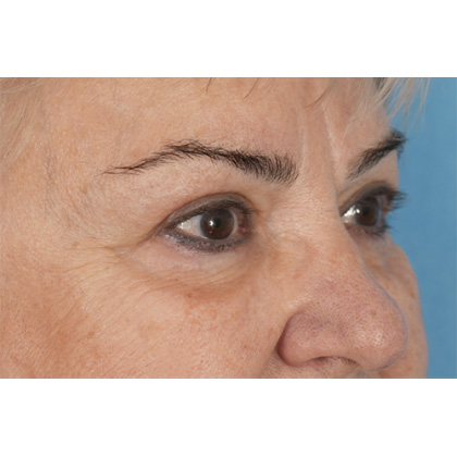 Upper Blepharoplasty Before & After Patient #702