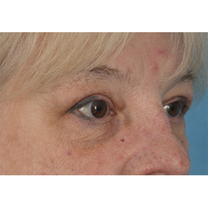 Upper Blepharoplasty Before & After Patient #728
