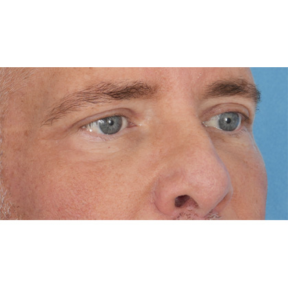 Upper Blepharoplasty Before & After Patient #699