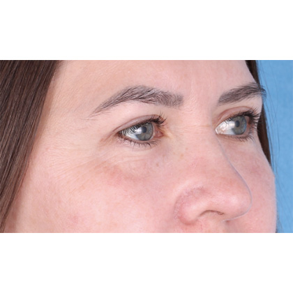 Upper Blepharoplasty Before & After Patient #698