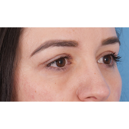 Upper Blepharoplasty Before & After Patient #700