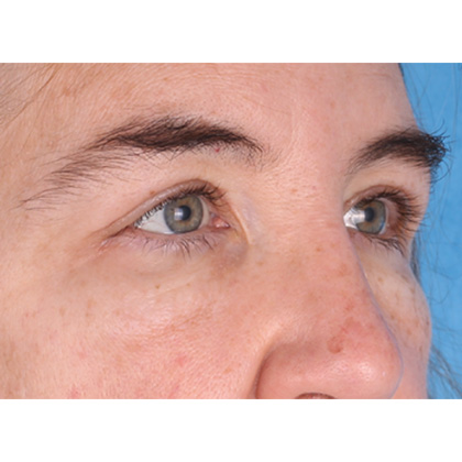 Upper Blepharoplasty Before & After Patient #813