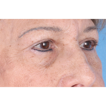 Upper Blepharoplasty Before & After Patient #814