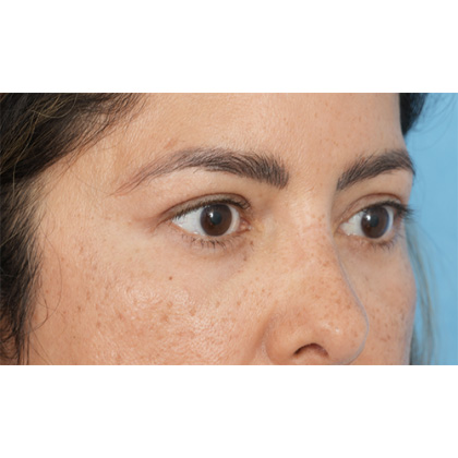 Four Lid Blepharoplasty Before & After Patient #397
