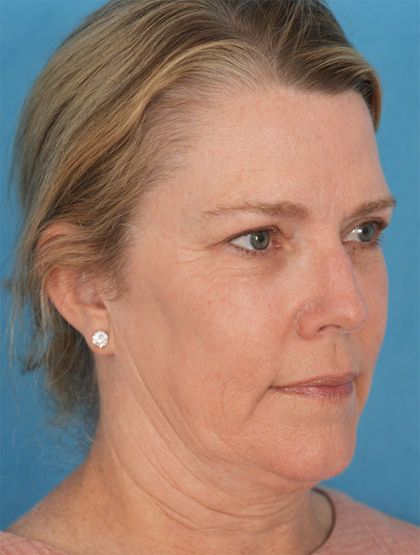 Four Lid Blepharoplasty Before & After Patient #394