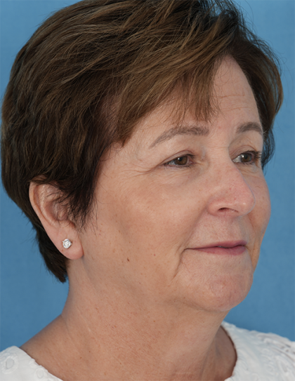 Four Lid Blepharoplasty Before & After Patient #401