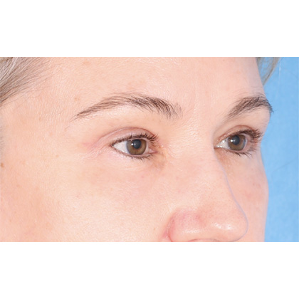 Four Lid Blepharoplasty Before & After Patient #399