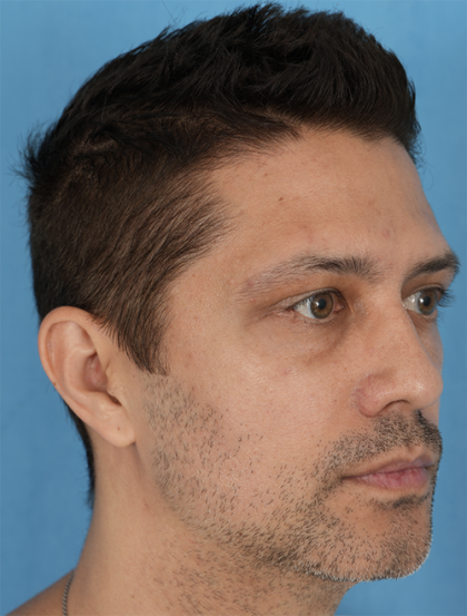 Lower Blepharoplasty Before & After Patient #527