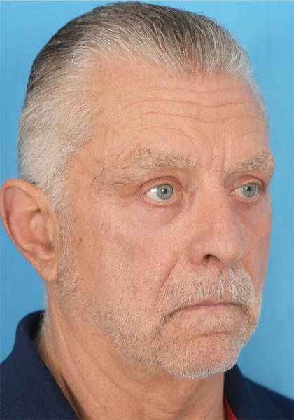 Four Lid Blepharoplasty Before & After Patient #396