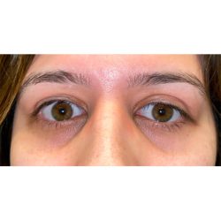 Retraction Repair Before & After Patient #827