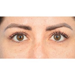Upper Blepharoplasty Before & After Patient #703