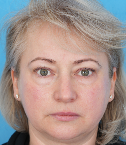 Four Lid Blepharoplasty Before & After Patient #393