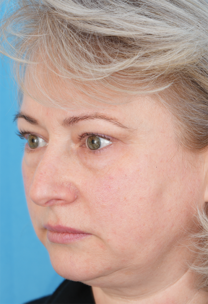 Four Lid Blepharoplasty Before & After Patient #393
