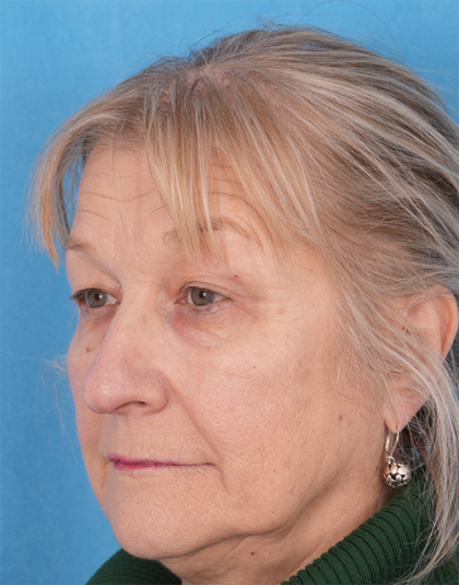 CO2 Laser Resurfacing Before & After Patient #392