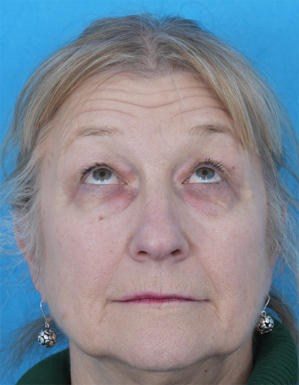 CO2 Laser Resurfacing Before & After Patient #392