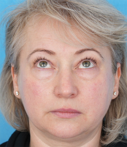 Four Lid Blepharoplasty Before & After Patient #393