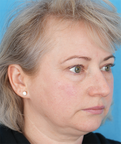 Four Lid Blepharoplasty Before & After Patient #393
