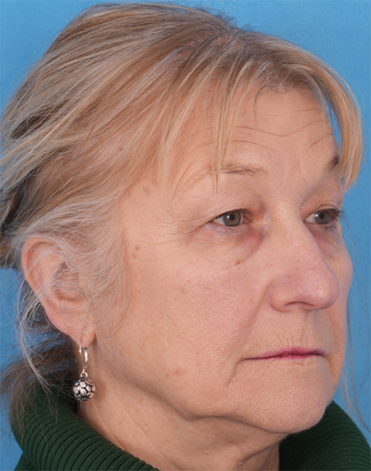 CO2 Laser Resurfacing Before & After Patient #392