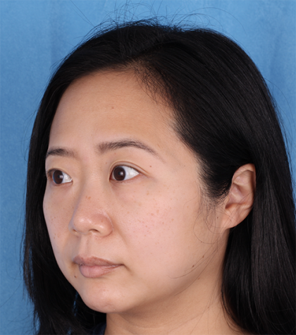 Lower Blepharoplasty Before & After Patient #524