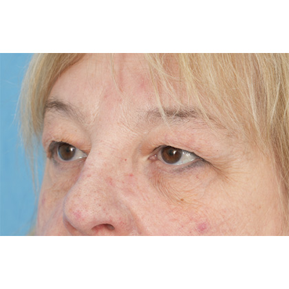 Upper Blepharoplasty Before & After Patient #728