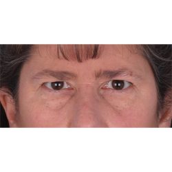 Brow Contour Before & After Patient #336