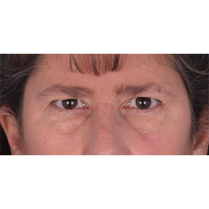 Brow Lift Before & After Patient #336