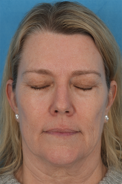 Four Lid Blepharoplasty Before & After Patient #394