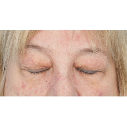 Upper Blepharoplasty Before & After Patient #728