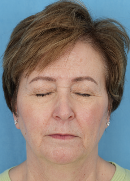 Four Lid Blepharoplasty Before & After Patient #401