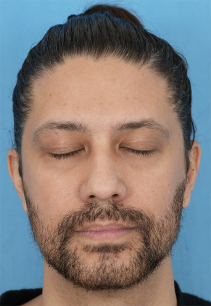 Lower Blepharoplasty Before & After Patient #527