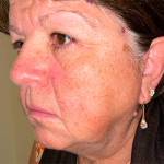 Face/Neck Lift Before & After Patient #387