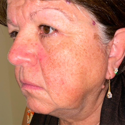 Facelift Before & After Patient #387