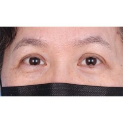 Lesion Removal Before & After Patient #353