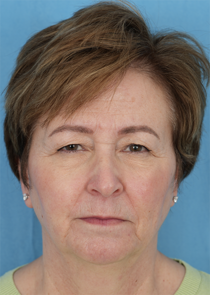 Four Lid Blepharoplasty Before & After Patient #401