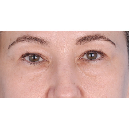 Four Lid Blepharoplasty Before & After Patient #399