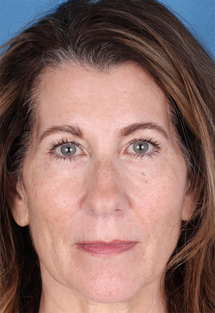 Lower Blepharoplasty Before & After Patient #525