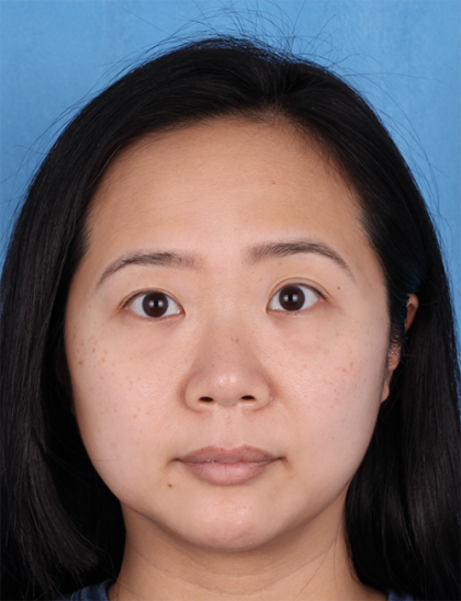 Lower Blepharoplasty Before & After Patient #524
