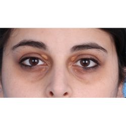 Lesion Removal Before & After Patient #360